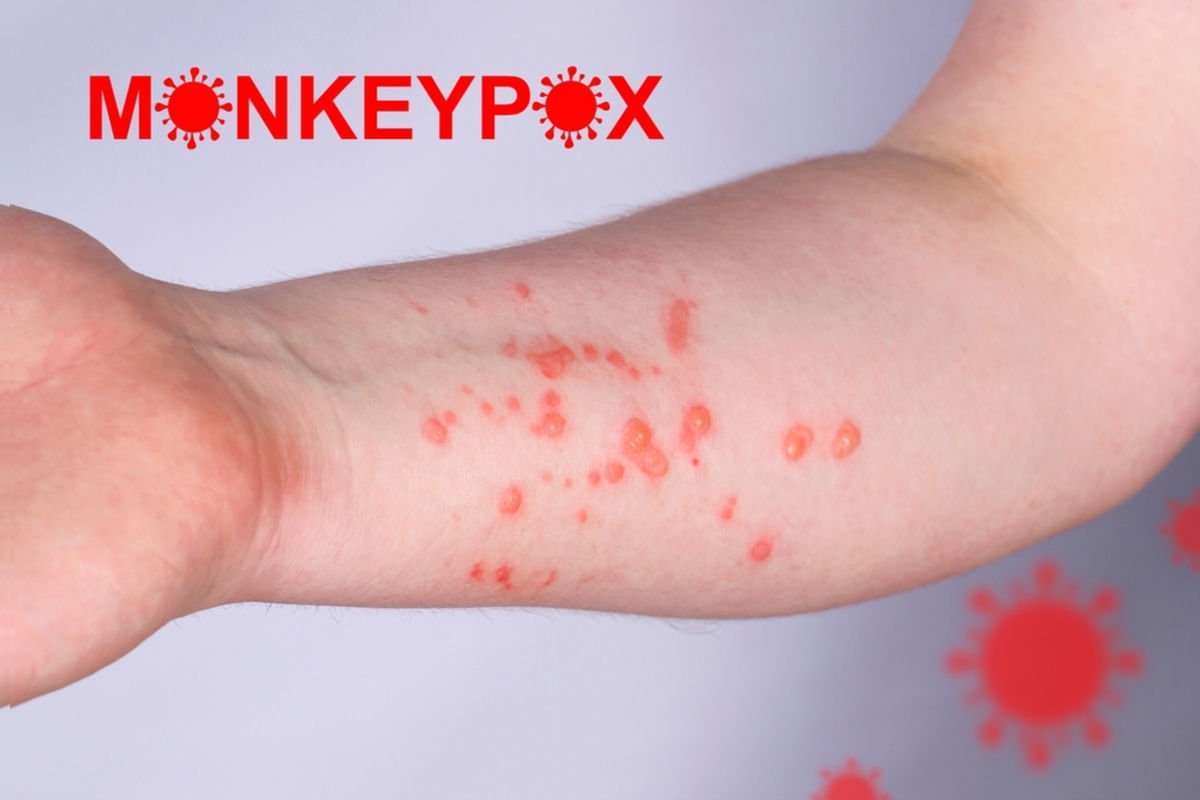Ny MPOX -sak bekreftet i Zaragoza, og markerer 198 spanske tilfeller i 2025