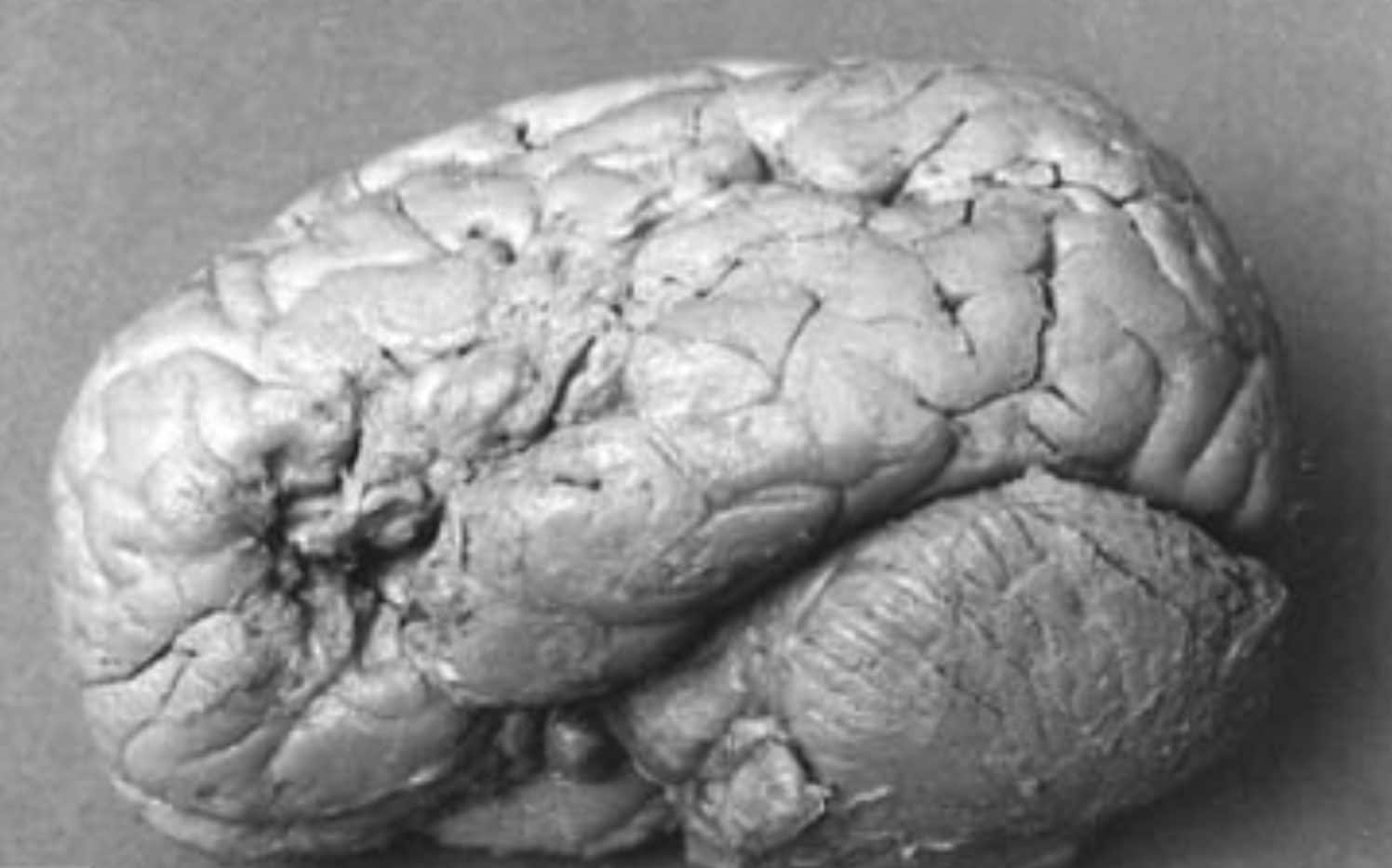 cervello paziente tan tan