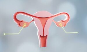 Hvorfor navnet på polycystisk ovariesyndrom har endret seg, er det nå Polyendocrine Metabolic Ovarian Syndrome (PMOS)